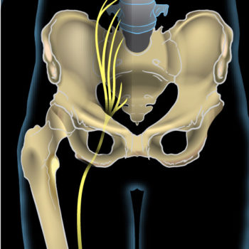 Sciatica